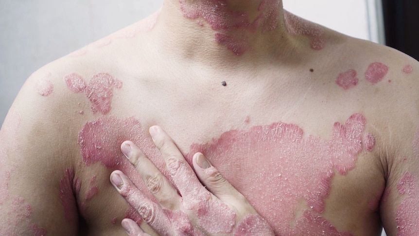 A man with a skin condition rests his hand on his chest