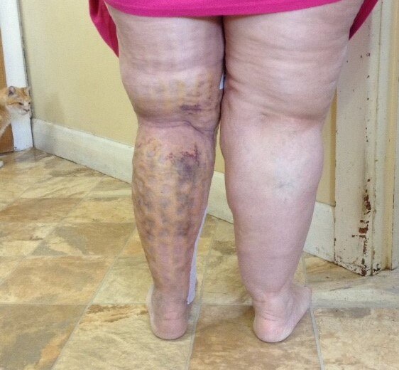 Rear view of a woman's legs, with left leg significantly thinner than her right