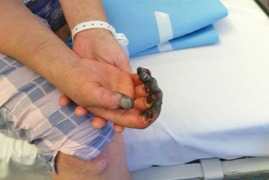 A woman holds her hand with blackened fingers evident.