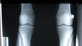 xray of joints