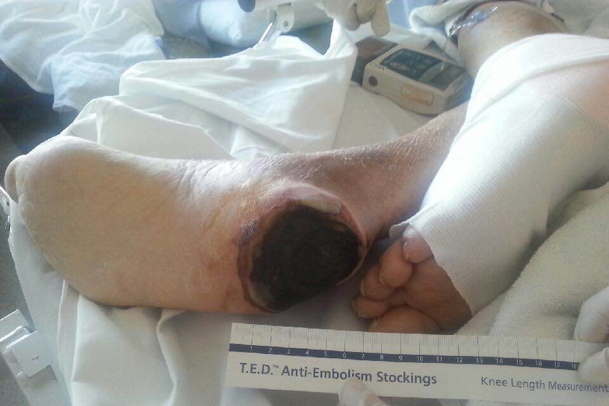 A hospital photograph shows gangrene on the heel of Zdenek Selir's foot.