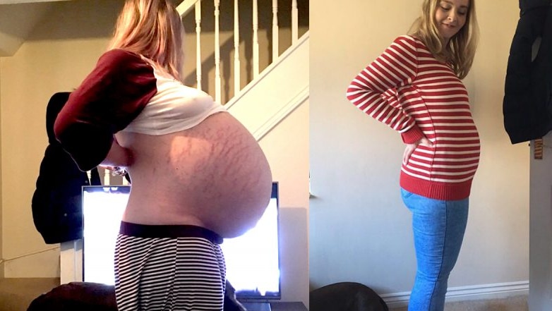 On the left Ms Favell shows her large swollen stomach. On the right she appears slim.