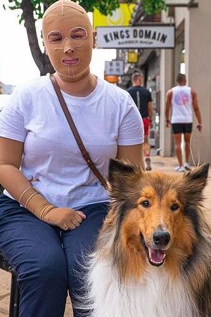 A woman wearing compression bandages on her face  and hands sits with a dog.