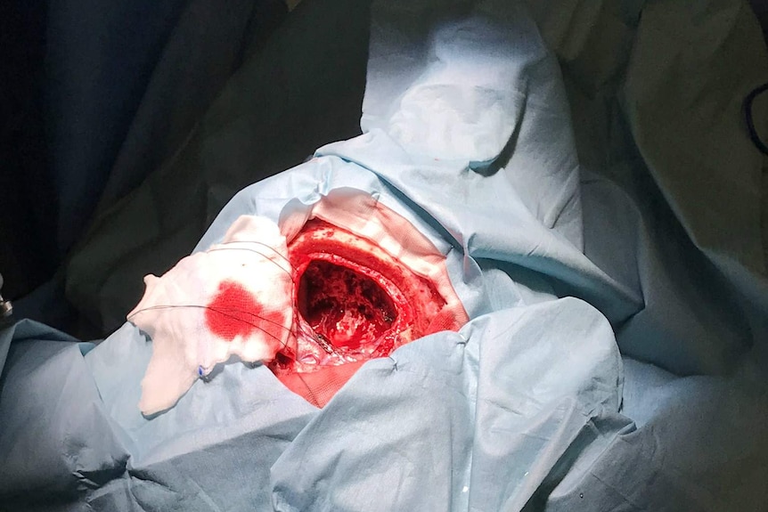 A gaping hole in a man's head after a tumour has been removed in surgery