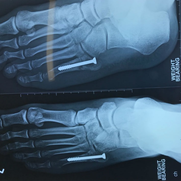 A medical scan showing Josh Green's feet. He has a bolt in each foot.