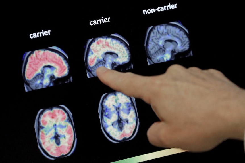 A finger pointing to the results of a brain scan 
