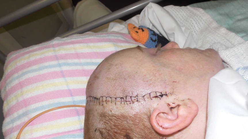 Close up of a woman's head in a hospital bed with stiches right across her head