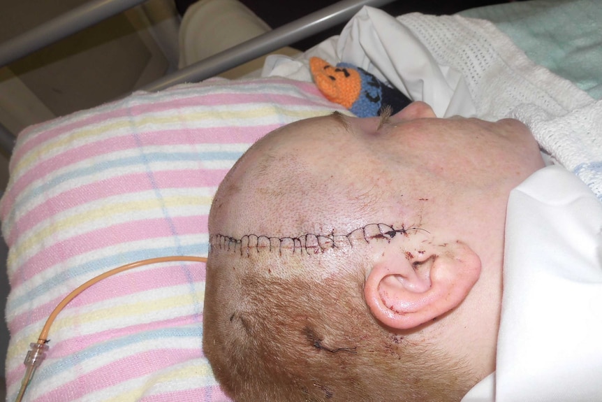 Close up of a woman's head in a hospital bed with stiches right across her head