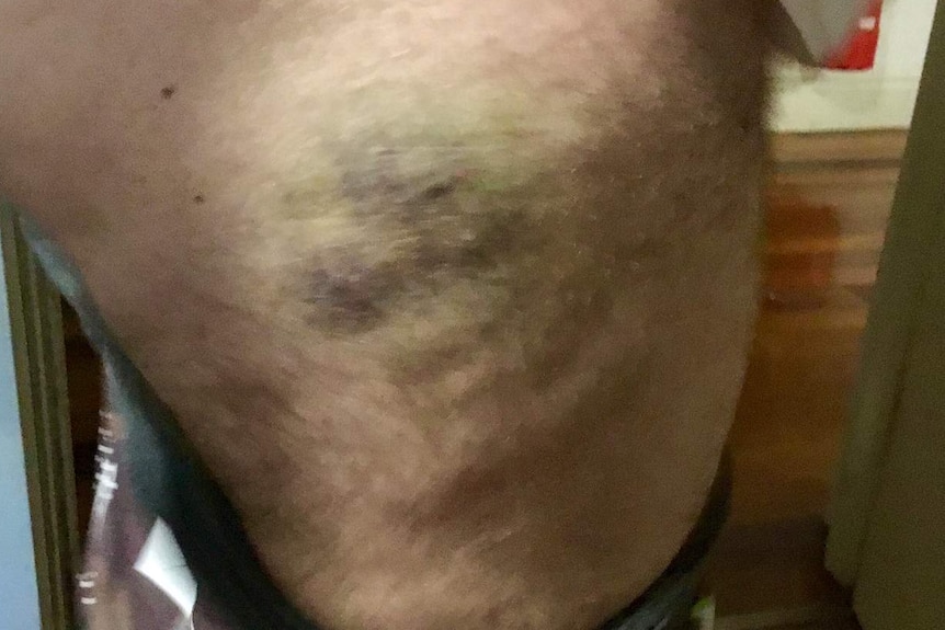 A closeup of a man's upper leg, which features a large yellow and purple bruise.