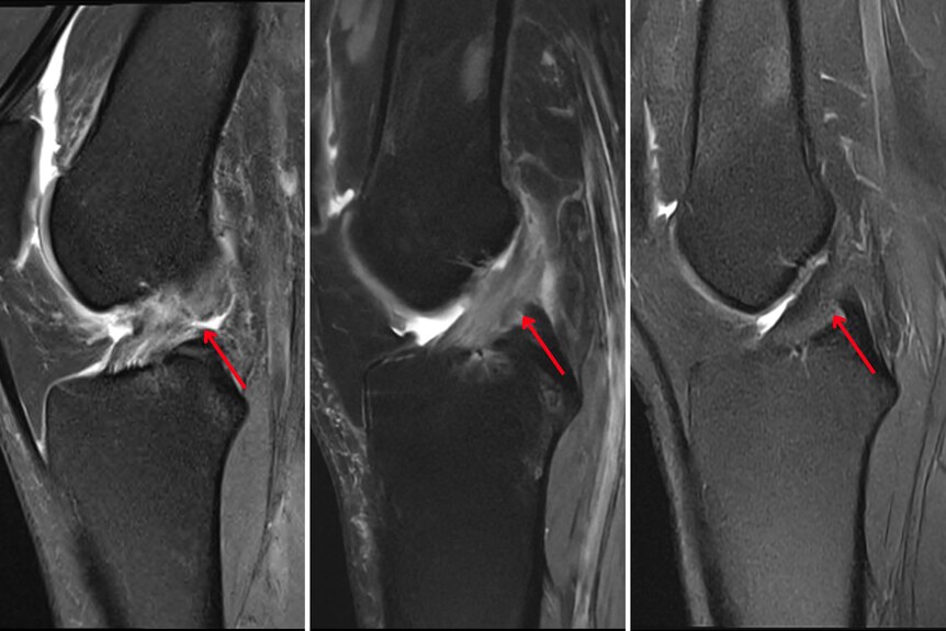 A composite image showing three MRIs of an ACL. The left shows it ruptured, the middle and right show it healing 