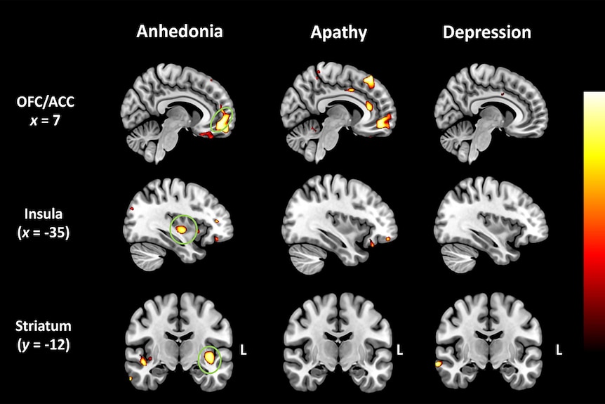 Brain imaging study of frontotemporal dementia patients