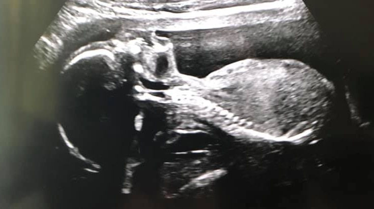 An ultrasound of Sara Hodder's baby Jaiga from the Mersey Community Hospital.