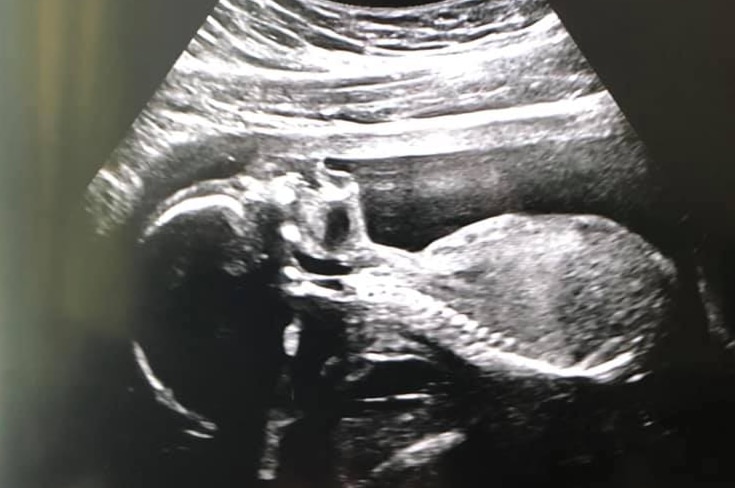 An ultrasound of Sara Hodder's baby Jaiga from the Mersey Community Hospital.