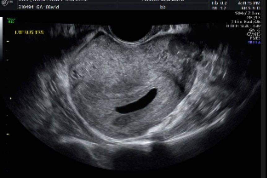 A black and white scan of Maria's stomach, dark black bean shape.
