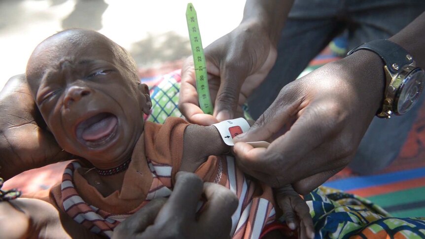 Malnourished baby in Borno, Nigeria