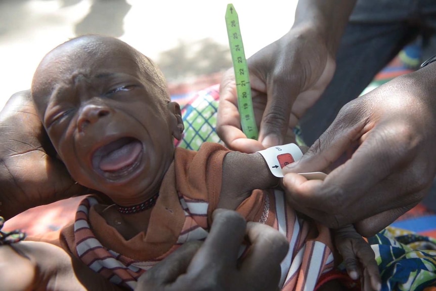 Malnourished baby in Borno, Nigeria