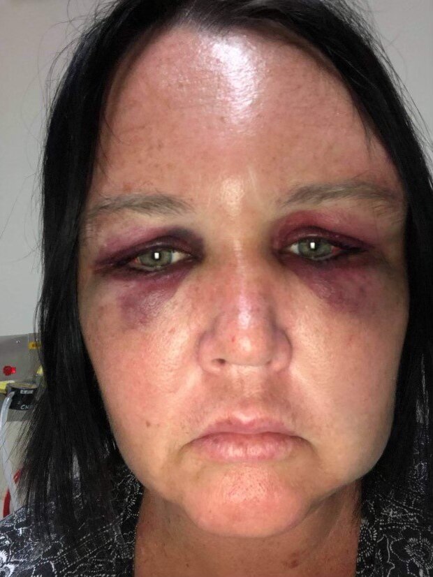 a woman with a bruised face looks at the camera