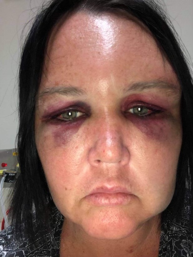 a woman with a bruised face looks at the camera