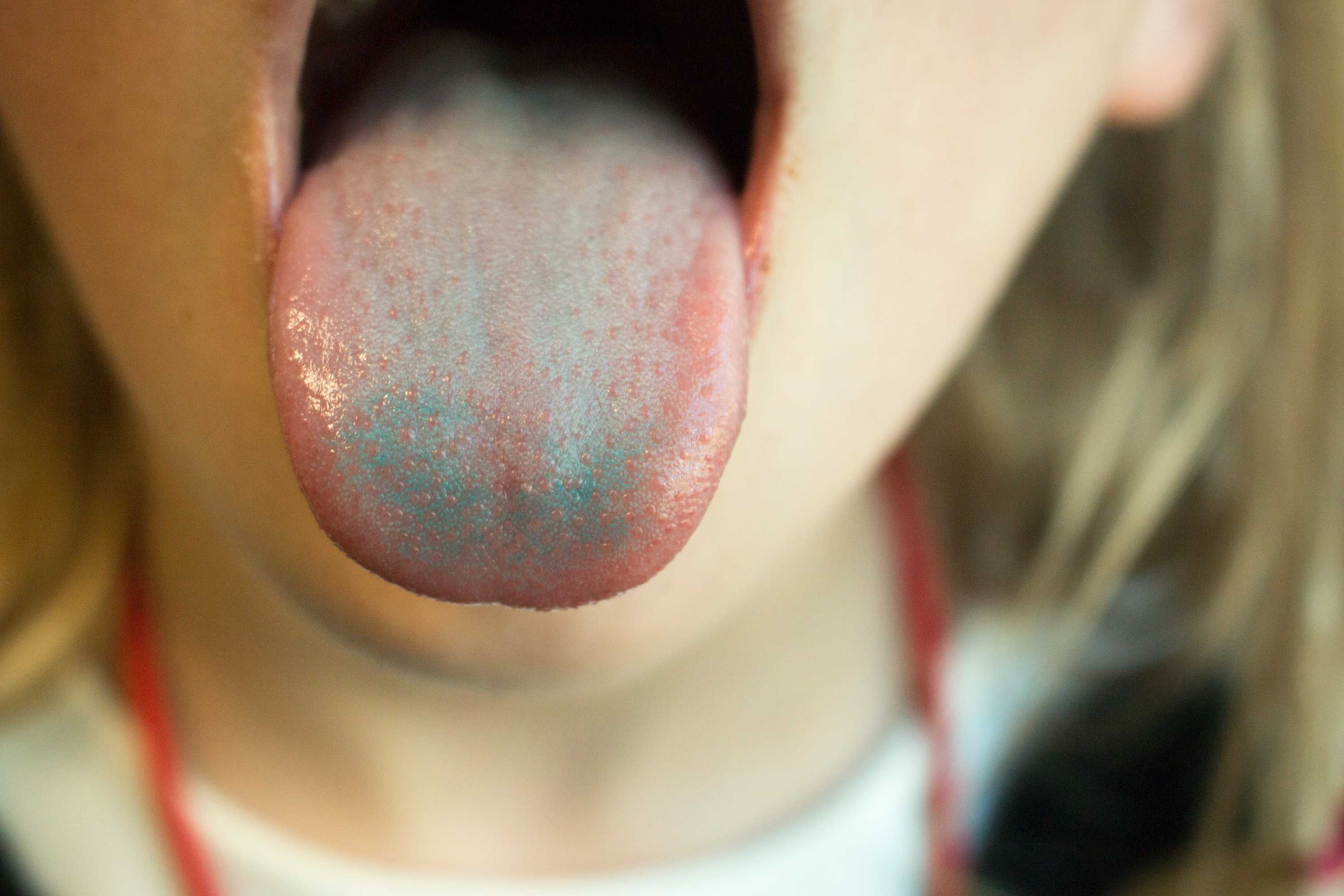 Super Tasters Non Tasters And How Your Tongue S Bumps May Affect Your Appetite Abc News