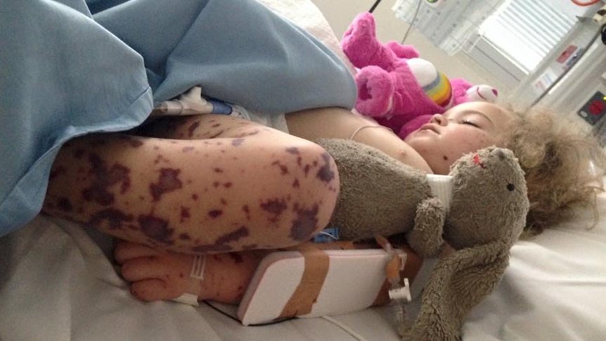 Meningococcal rash on a child's leg