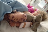 Meningococcal rash on a child's leg