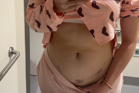 A woman raises her top in the mirror to show scars from surgery from endometriosis