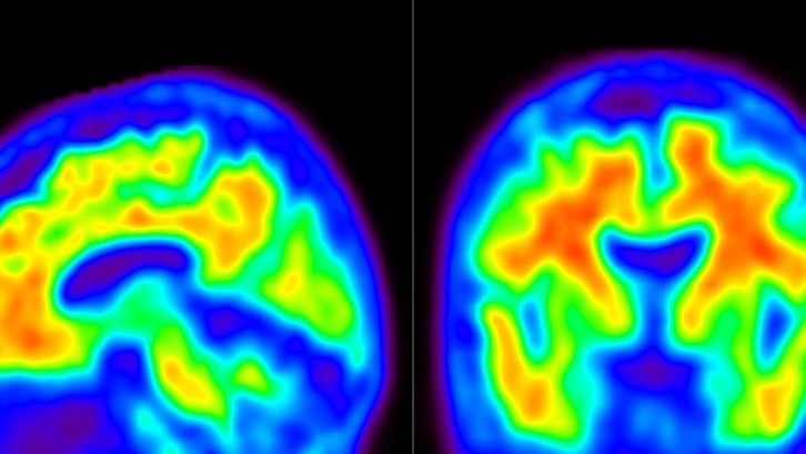 Brain scans showing amyloid in Alzheimer's disease, with the shape of a head filled in with colour representing scan results