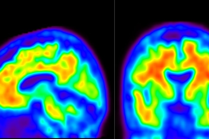 Brain scans showing amyloid in Alzheimer's disease, with the shape of a head filled in with colour representing scan results
