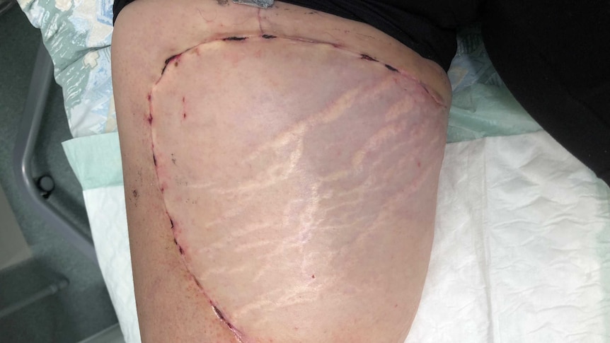 A large section of skin grafted onto Justine Barwick's thigh.