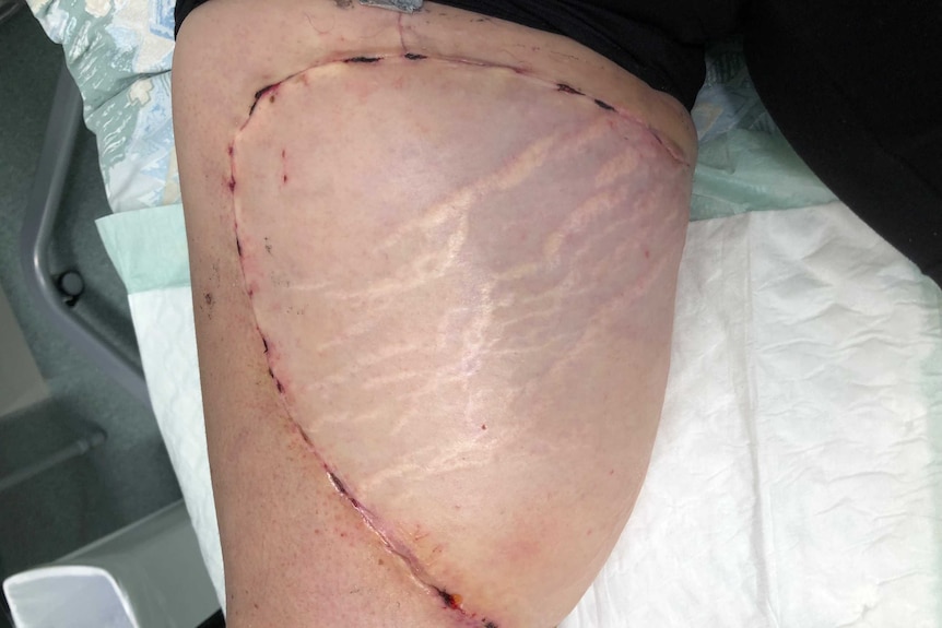 A large section of skin grafted onto Justine Barwick's thigh.