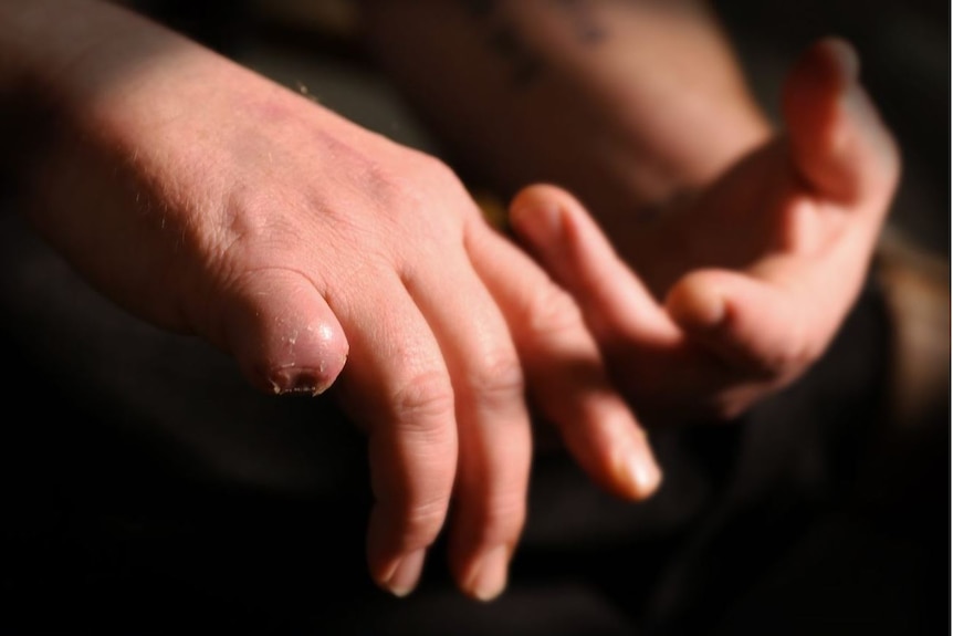 Mental health patient Seth cut a finger off