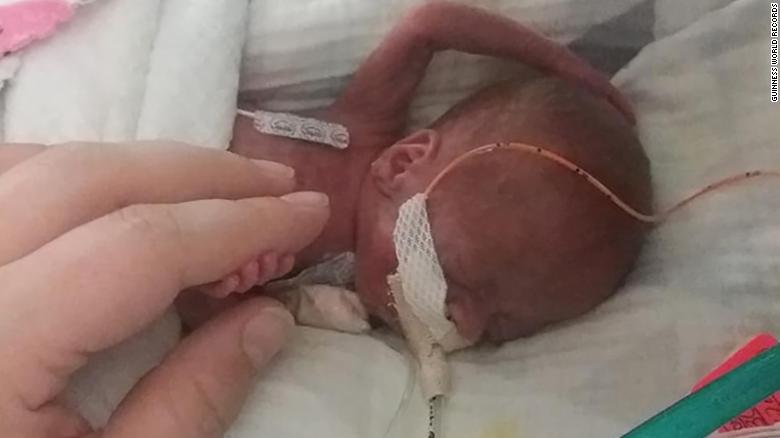 Baby in intensive care with tube attached to his body, with an adult's  hand showing his tiny size.
