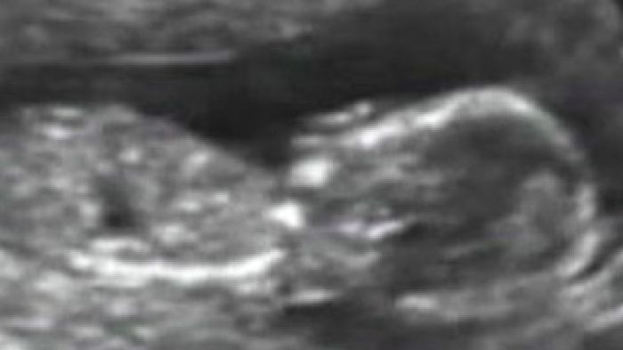TV still of an ultrasound of a human foetus