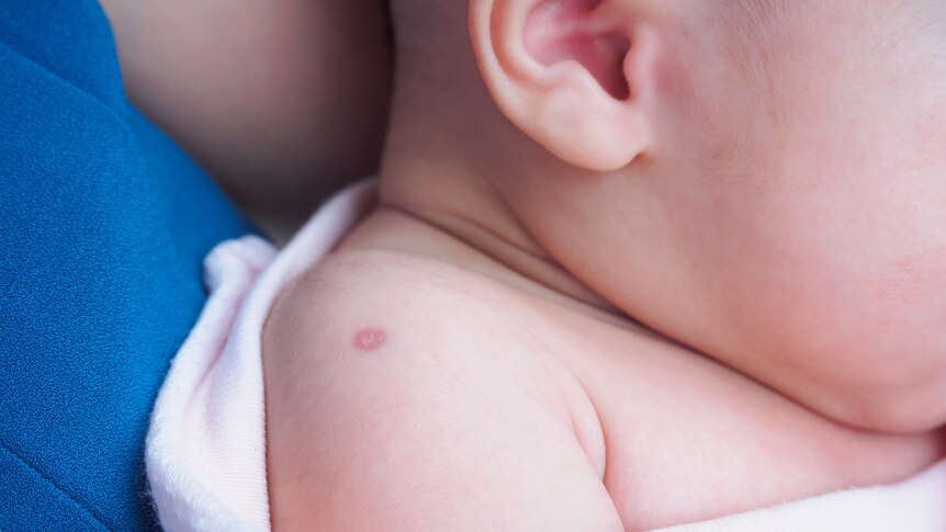 close up of child's shoulder with vaccine mark on arm