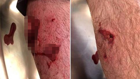 Graphic pixellated close-up images of leg with dog bites.