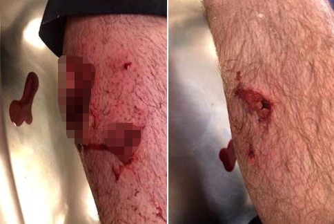 Graphic pixellated close-up images of leg with dog bites.