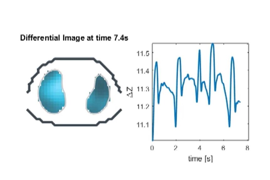 Image d'ordinateur montrant un graphique surveillant la respiration d'un nourrisson.