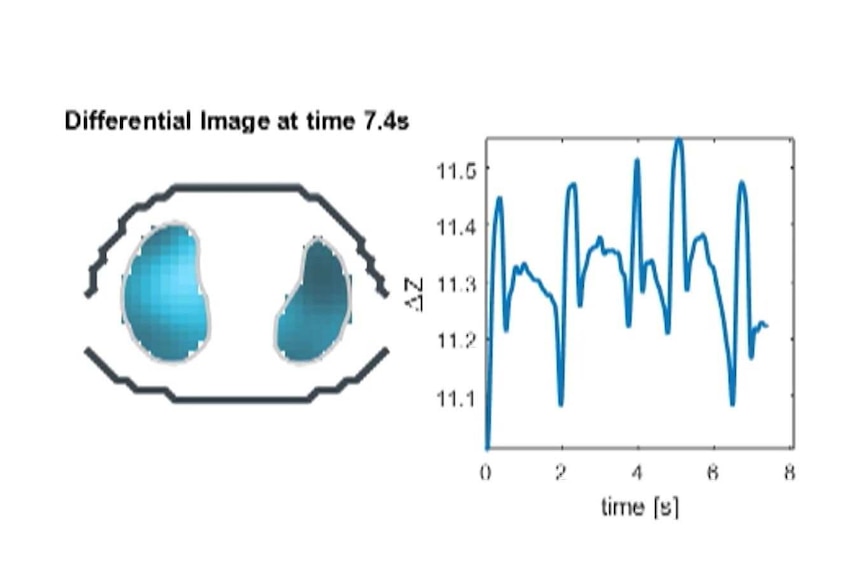 A computer image showing a graph monitoring breathing in an infant.