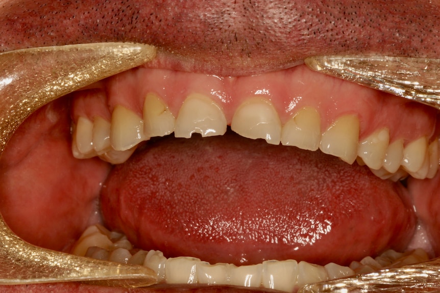 Damage to teeth caused by grinding with wear and chips to front teeth
