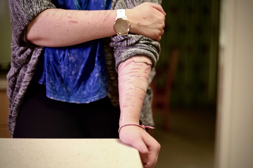 A young woman rests her arms on a kitchen bench, revealing scars from self-harming.