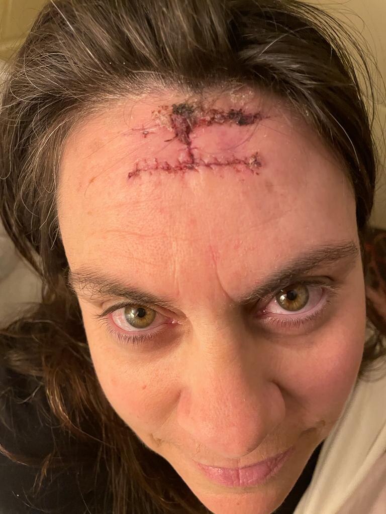 An 'I' shaped scar on a woman's forehead.