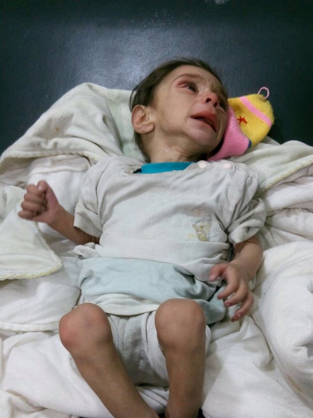 Starving baby in Madaya