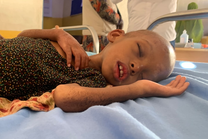 Thin and sickly looking child lying asleep on a hospital bed.