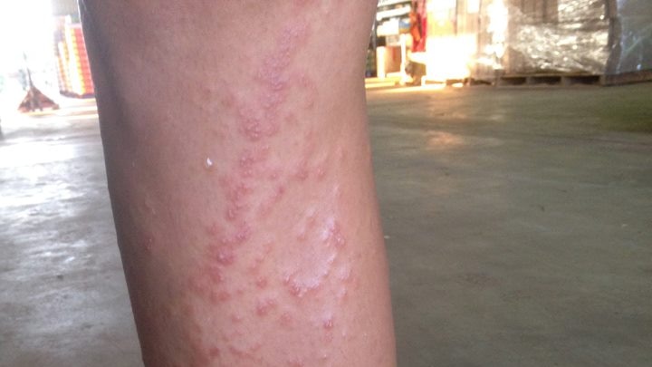 a leg with mango dermatitis