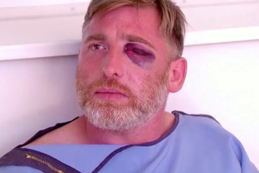 A man wearing a hospital gown with a black eye that's swollen shut.