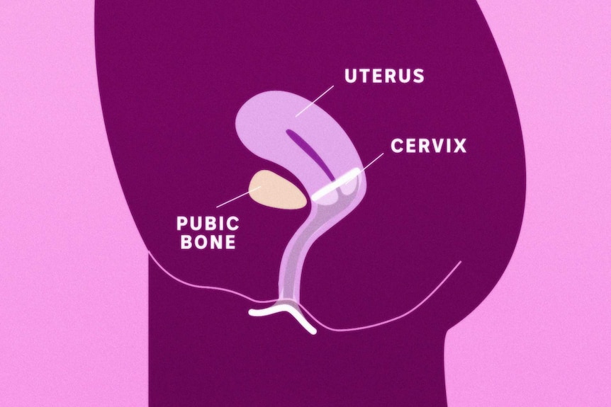 Female Condom Diagram