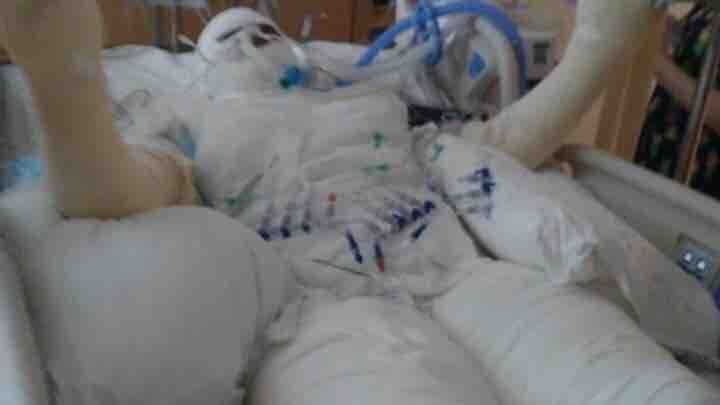 Timiyah Landers lying on a hospital bed covered head to toe in white bandages.