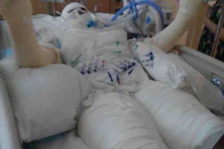 Timiyah Landers lying on a hospital bed covered head to toe in white bandages.