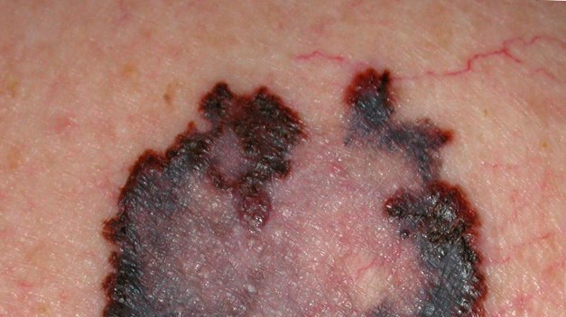 A close-up photo of a melanoma.