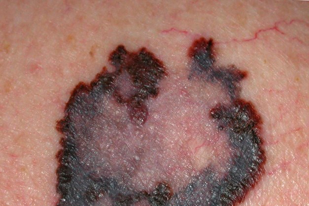 A close-up photo of a melanoma.